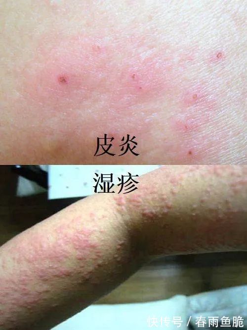 湿疹治疗