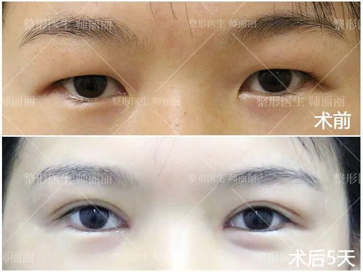 组织|双眼皮术后出现肉条的不同原因和修复方法