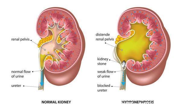 肾脏|除了肾病,这6种情况不重视,也会诱发尿毒症,需了解