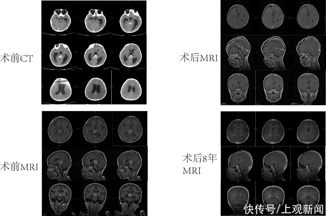 恶性肿瘤|松果体母细胞瘤并非治愈无望!3岁男孩术后8年未复发