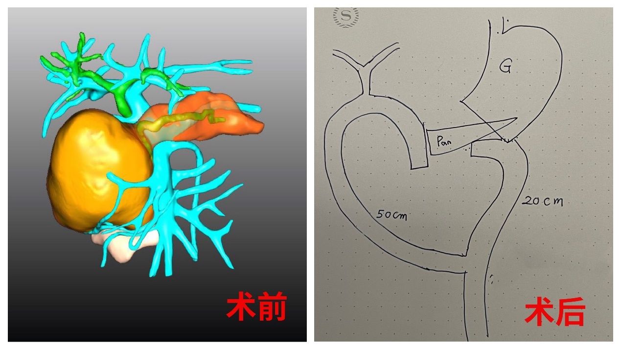 锦旗|“谢谢我爱的肝胆外科”！17岁“二次元”少女出院前手绘锦旗送医护人员
