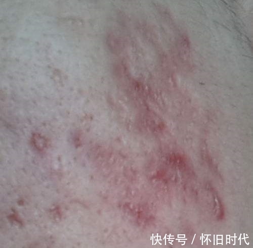 在这个看脸的社会,不注意这些,小心痘印“毁容”