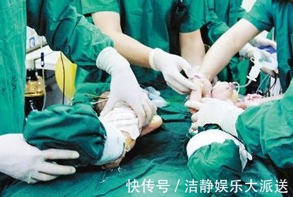文章|孕妇怀连体婴拒绝引产,宝宝出生后,整个医院都沸腾了