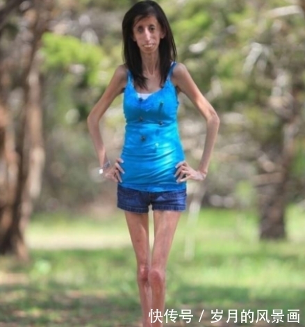 纪录|曾破吉尼斯最瘦纪录的骷髅女孩，只有27公斤，如今成励志女孩