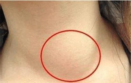 早期症状|“最善良的癌”—甲状腺癌,四个早期症状,不得忽视