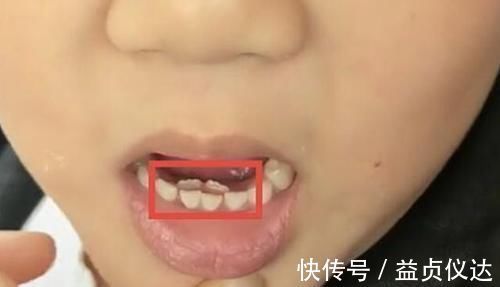 奶奶|7岁男孩长了“双排牙”,需要一颗一颗拔掉,奶奶自责不已