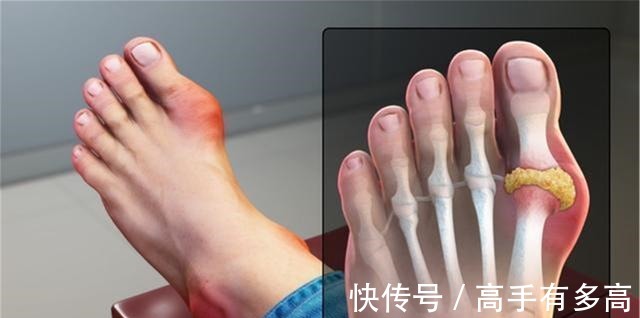 痛风|有痛风，能吃豆腐吗医生送你1条饮食口诀，让尿酸降得又快又好