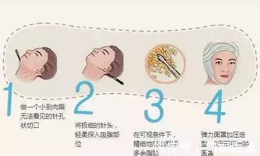 面部吸脂 面部吸脂后头套一般戴多少天?想要术后不松弛这两点要注意!