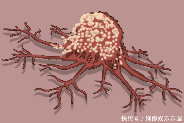 癌细胞也会主动消失医生提醒在4种情况下,确实会有惊喜
