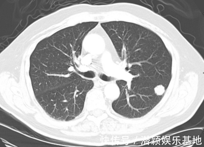 戒烟|吃一次等于5斤海带，主任：没事喝2口，散“结节”，肺越来越红润