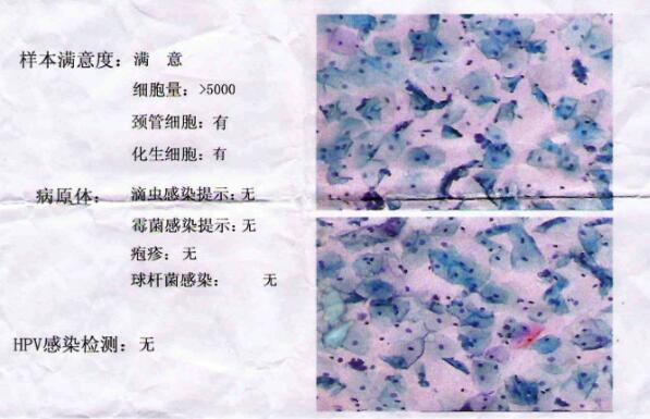 提高免疫力|32岁女子查出宫颈癌,自称没有任何疼痛感,但是2个指标要重视