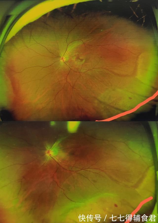 陈忠平|想做近视手术，却被检查出视网膜脱离，24岁小伙吓坏了