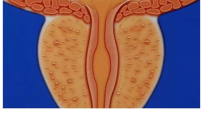 前列腺病变|一个月“排精”10次可缓解前列腺炎？医生解答：多吃1物，炎症慢慢消除