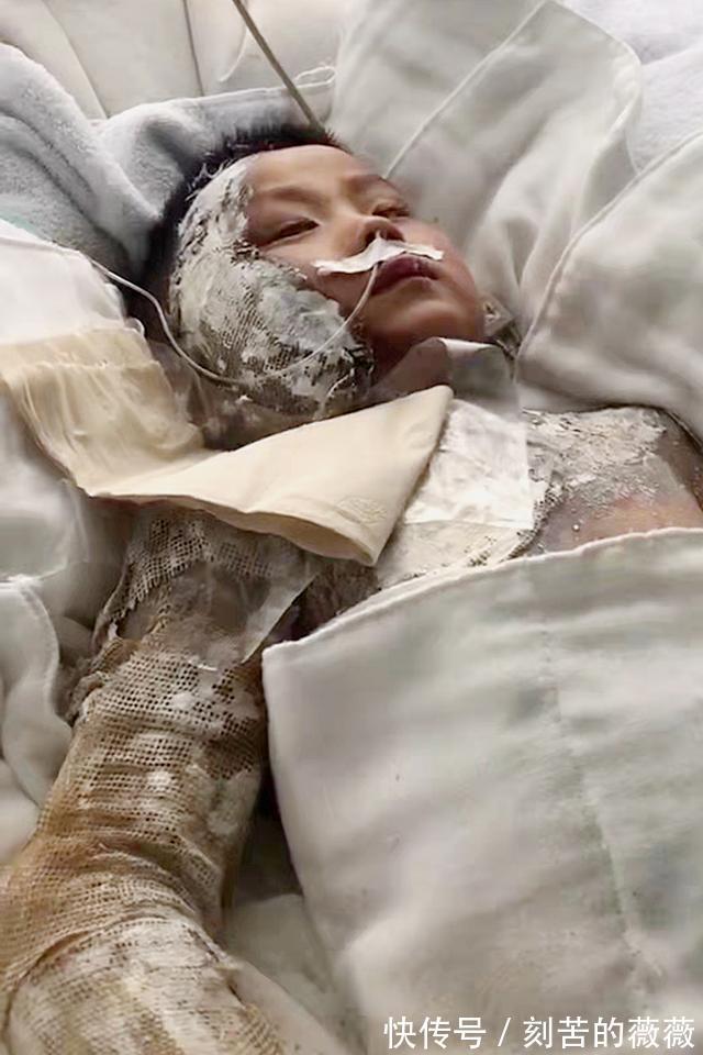太阳能|热水器老化爆裂烫伤6岁男孩,治疗费已超百万,家长始终不愿放弃