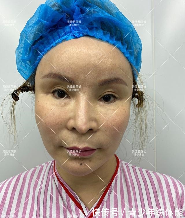 拉皮 小拉皮术后6个月,让她从老阿姨逆袭小姐姐!