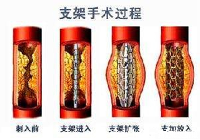 导管|血管支架能穿进人的血管，为何不直接用支架把血管里的血栓吸出