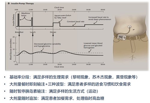 糖友|美敦力胰岛素泵告诉你为什么戴泵比打针好？