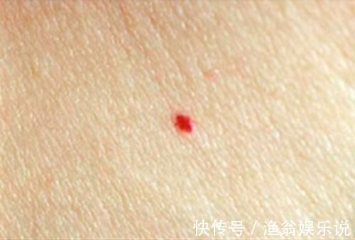 红痣|你的身上长有这种小红痣吗 一定不要大意!