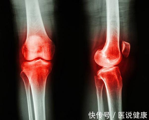 身体免疫力|想要区分关节炎和痛风,牢记这5点,或能帮你区分,需了解