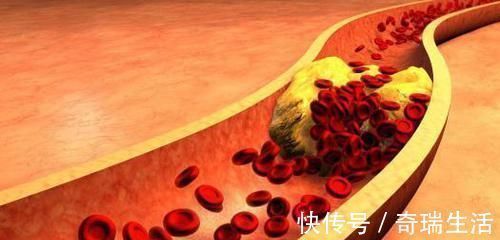 维生素e|有5种食物是降血脂“能手”,清除坏胆固醇,调整血脂状态