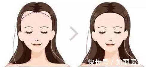 发际线 植发一般需要多少钱,种植发际线一万元够吗?