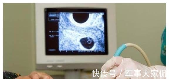 胎囊|胎儿发育的好坏,B超单上就告诉你了,这四个数据你能看懂