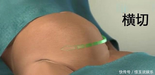 十月怀胎|生孩子剖腹产时横切和纵切哪个好好多人都选错了