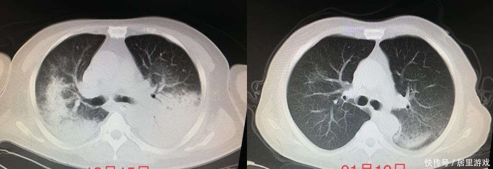 恐怖的“白肺”!男子呼吸紧促险休克!竟与养的鸡鸭有关?