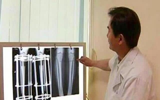 孩子“不长个”前,骨骺线会发出3个信号,家长早发现能再长5厘米