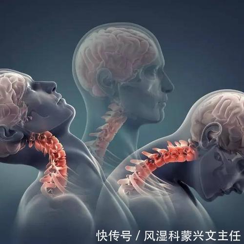  症状|颈椎病的八个等级，看看你到第几级了？