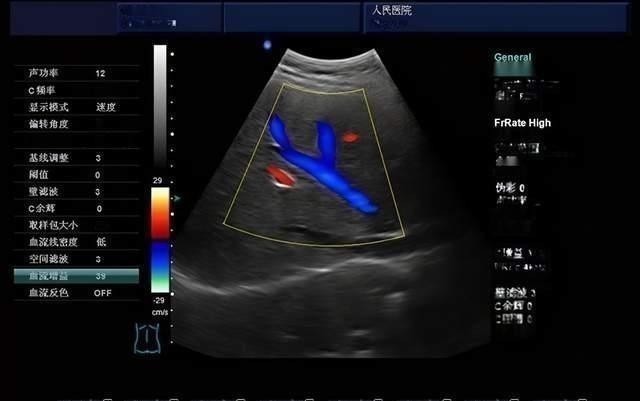 伦琴|做B超前涂的那层黏黏的、凉凉的液体是什么?做完要马上洗掉吗?