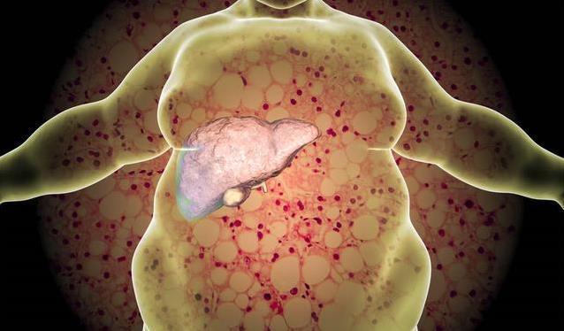 肝病不能拖!如果饭后出现这3个表现,肝硬化或已离你不远