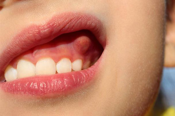 口腔溃疡|嘴上经常长泡，是怎么回事可能是这4种疾病的“信号”，别忽视