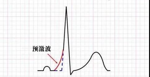 预激综合征|【健哥说心脏】心脏多了一条“ETC”通道——预激综合征