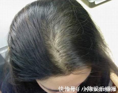 发际线|4款公认直呼好用的防脱洗发水,难怪别人发量惊人,看看你用过没