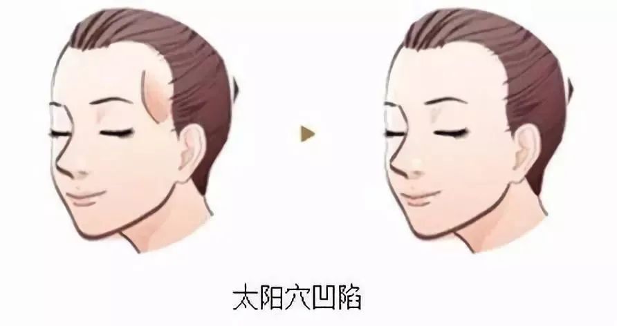 自体脂肪丰面颊|面部填充玻尿酸vs自体脂肪如何选?丨科普篇