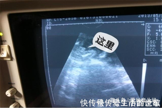 小玲|女子怀孕7个月,胎儿突然停止胎动?“嘴馋”或成罪魁祸首