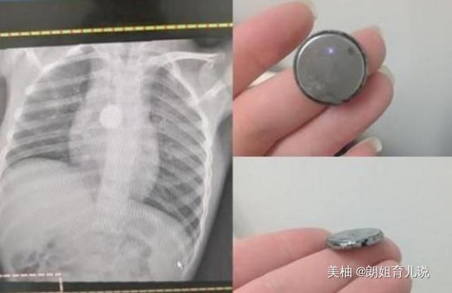 妈妈|5岁女儿暴瘦,医生检查让摘下“项链”,妈妈却说女儿没有戴项链