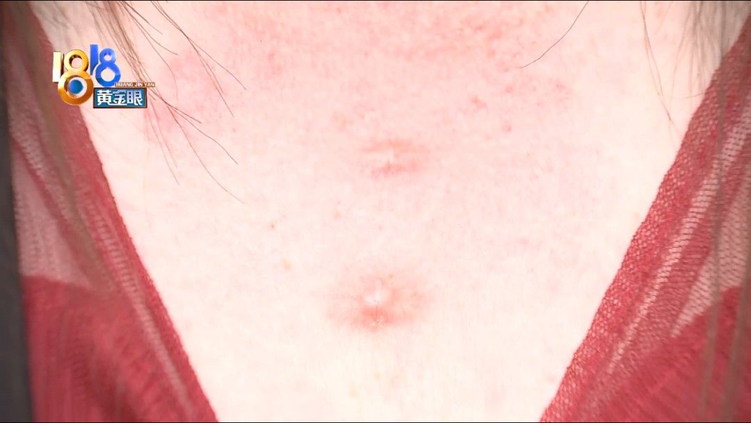 店员|“好漂亮”点痣后，长出两个疙瘩