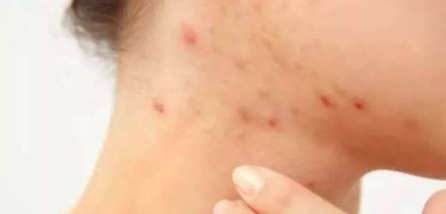 高二女生,因一壶蒲公英水,被送入医院,蒲公英泡水,有4大禁忌