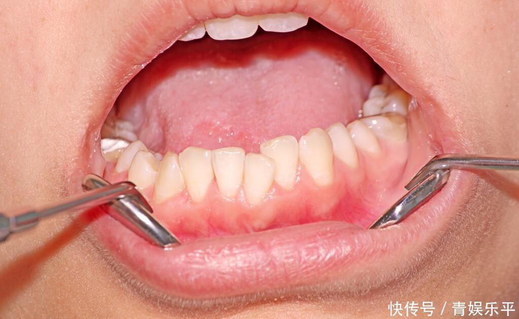 令人惊奇男子牙缝长出嫩芽,疼到不行专业医生分析…
