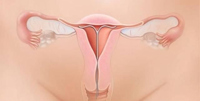 下腹|不想生二胎了上环还是结扎,看完这两位宝妈的遭遇你会选什么?