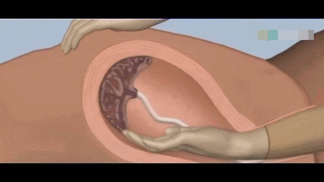 分娩|为什么有些产妇生完孩子后,胎盘不能自动娩出,还需要手剥胎盘