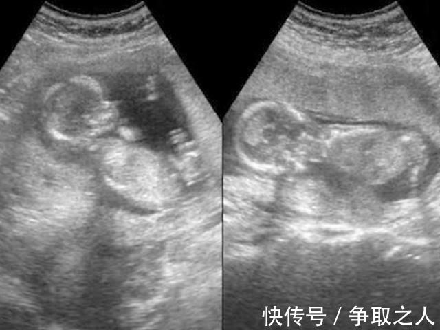 流产|25岁妈妈怀孕7个月引产,看到胎儿的那一刻,她彻底沉默了