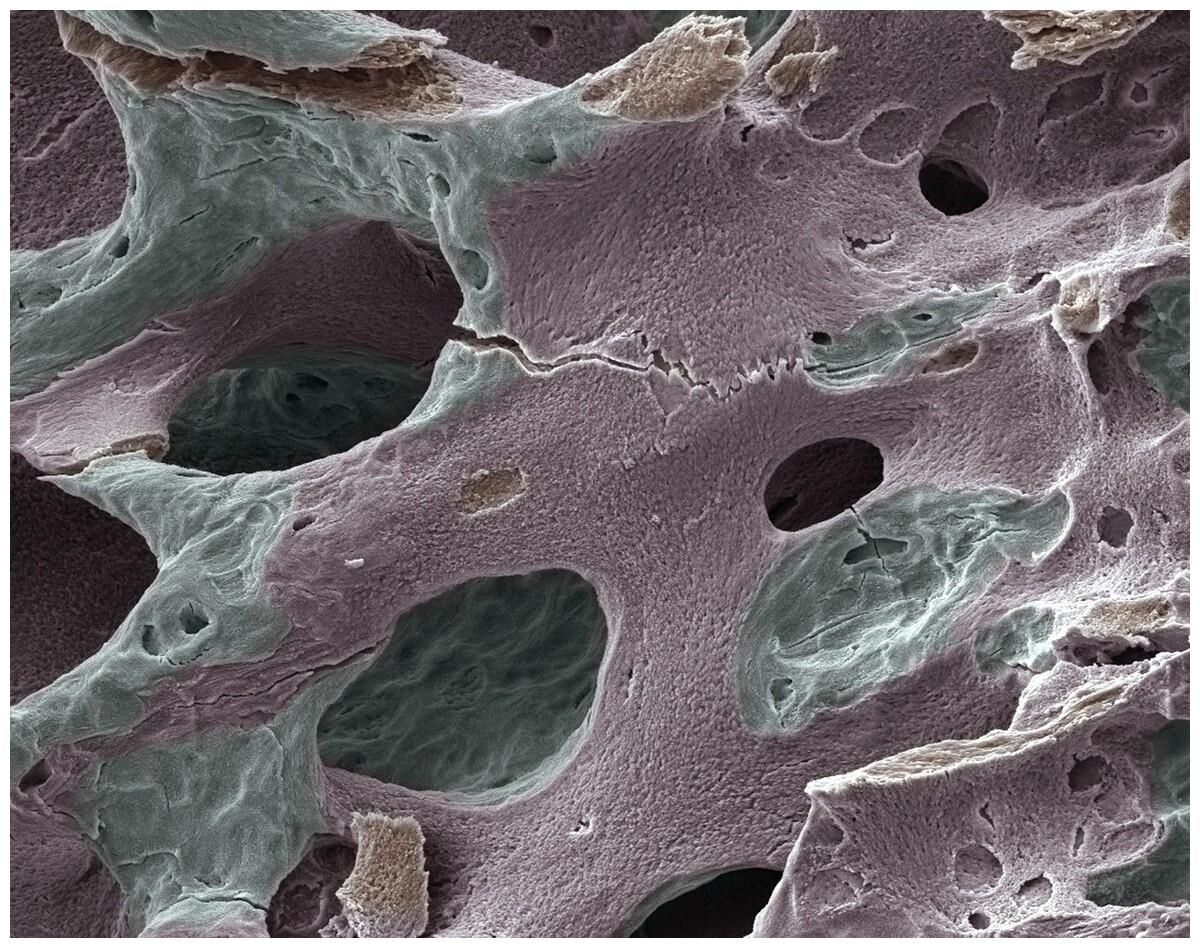 年龄越大骨流失越快，医生忠告：不想骨质疏松，“3绿”尽量少吃