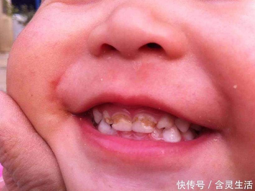牙医|4岁孩子一嘴黑牙,妈妈毫不在意认为牙齿能换,牙医叹气无知