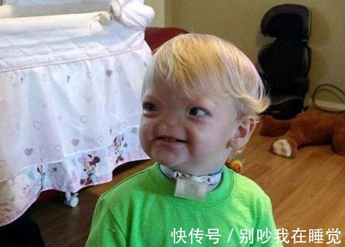男婴|2岁男婴竟无鼻生活两年，随后发生的事让人落泪