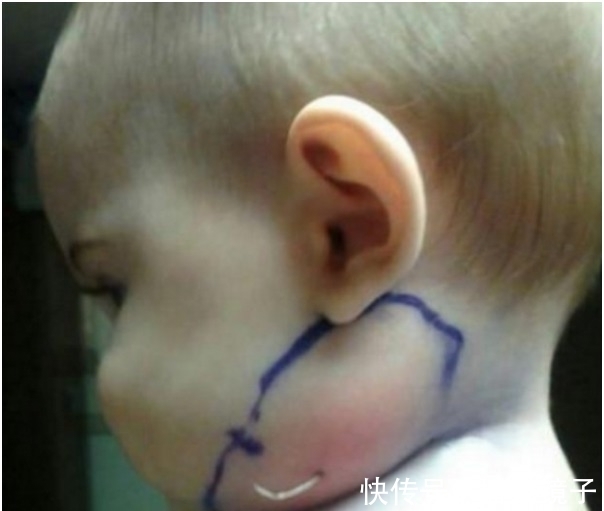 女婴|父母带着脖子突出一根东西的女婴去医院 一往外拉连医生都吓傻