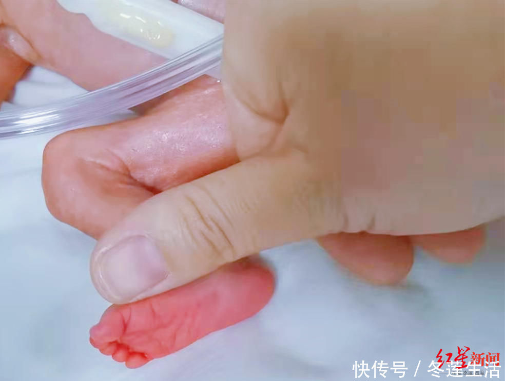 出院|早产女婴出生体重仅550g 历经102天救治顺利出院