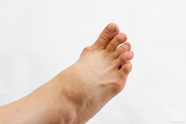 疾病|痛风和风湿性关节炎根本不是同一回事，本文来细数它们之间的区别